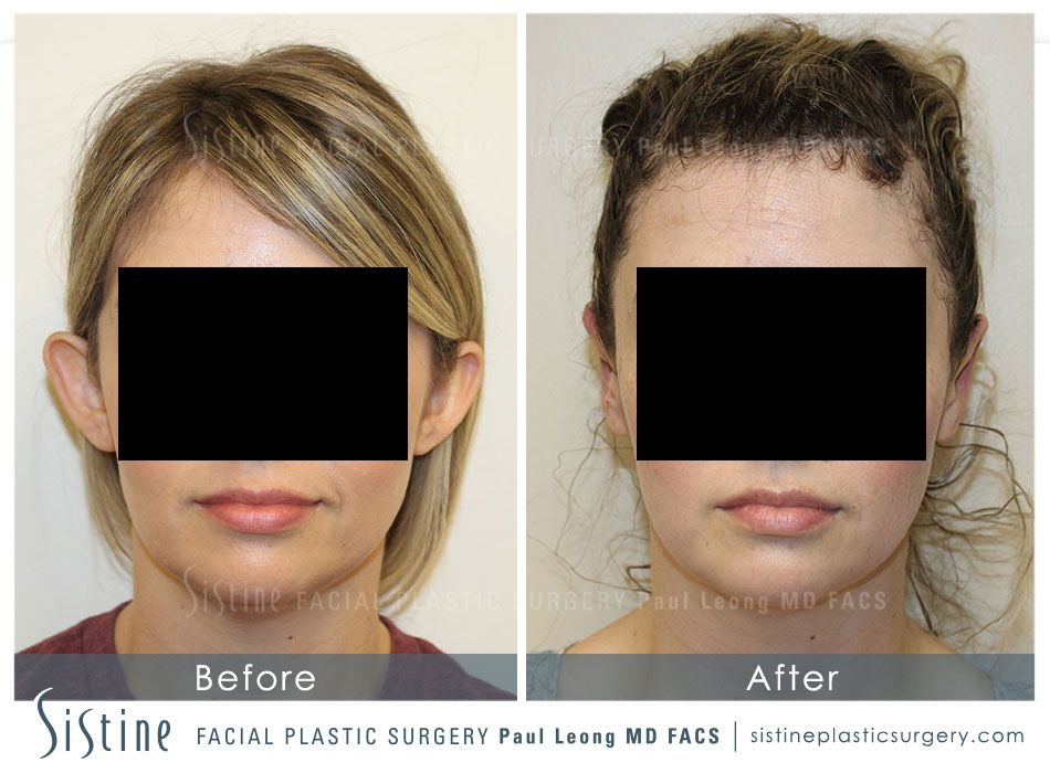 Otoplasty Before and After | Leong Facial Plastic Surgery