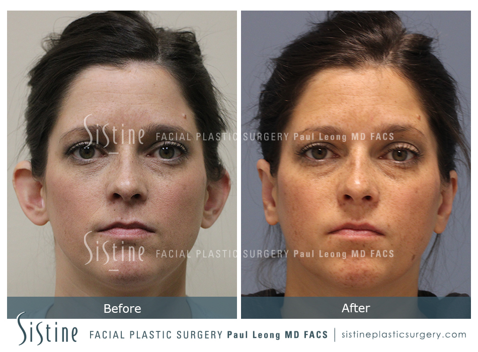 Otoplasty Before and After | Leong Facial Plastic Surgery