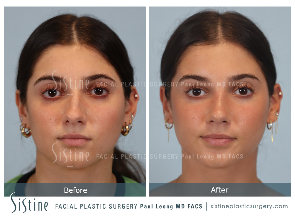 Rhinoplasty Before and After | Leong Facial Plastic Surgery