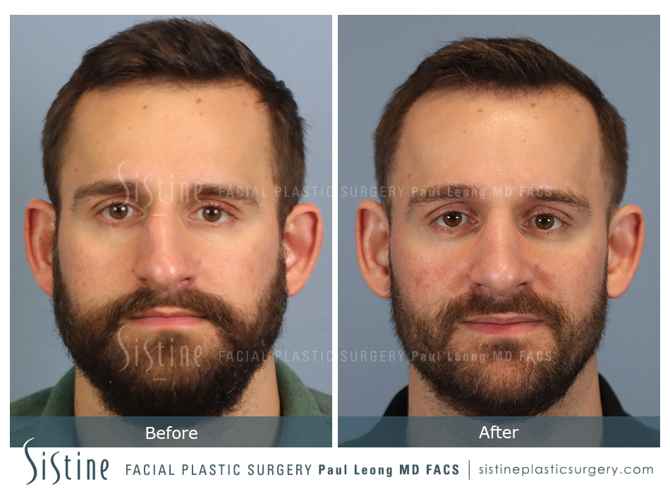 Rhinoplasty Before and After | Leong Facial Plastic Surgery