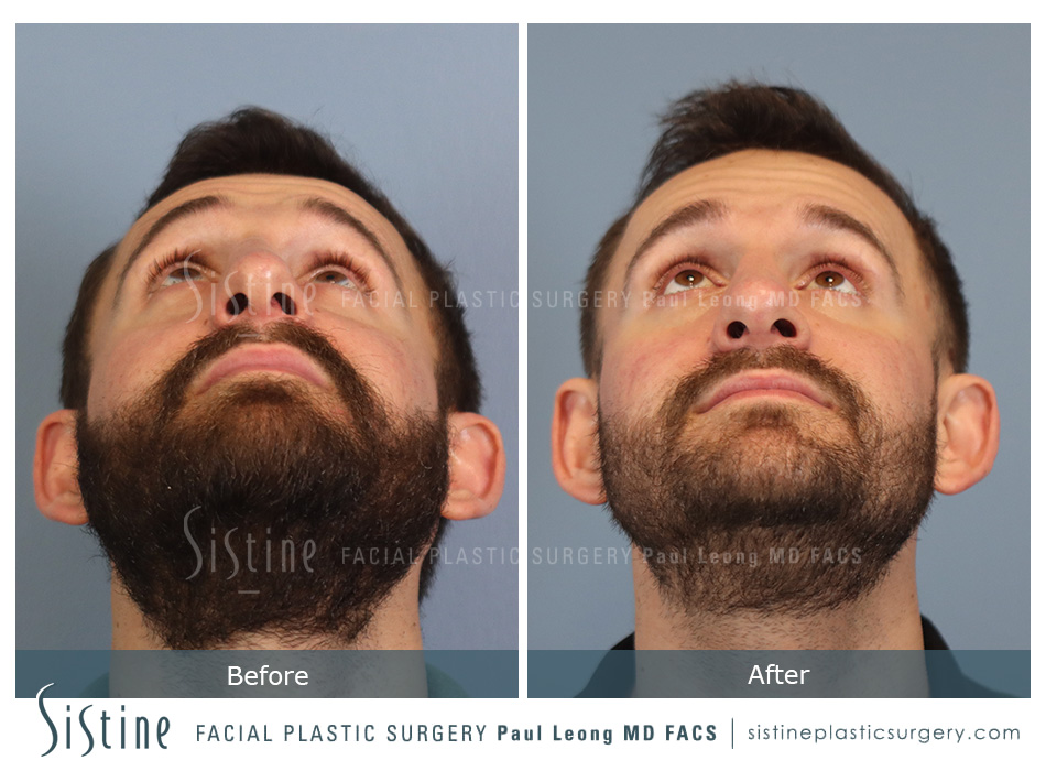 Rhinoplasty Before and After | Leong Facial Plastic Surgery