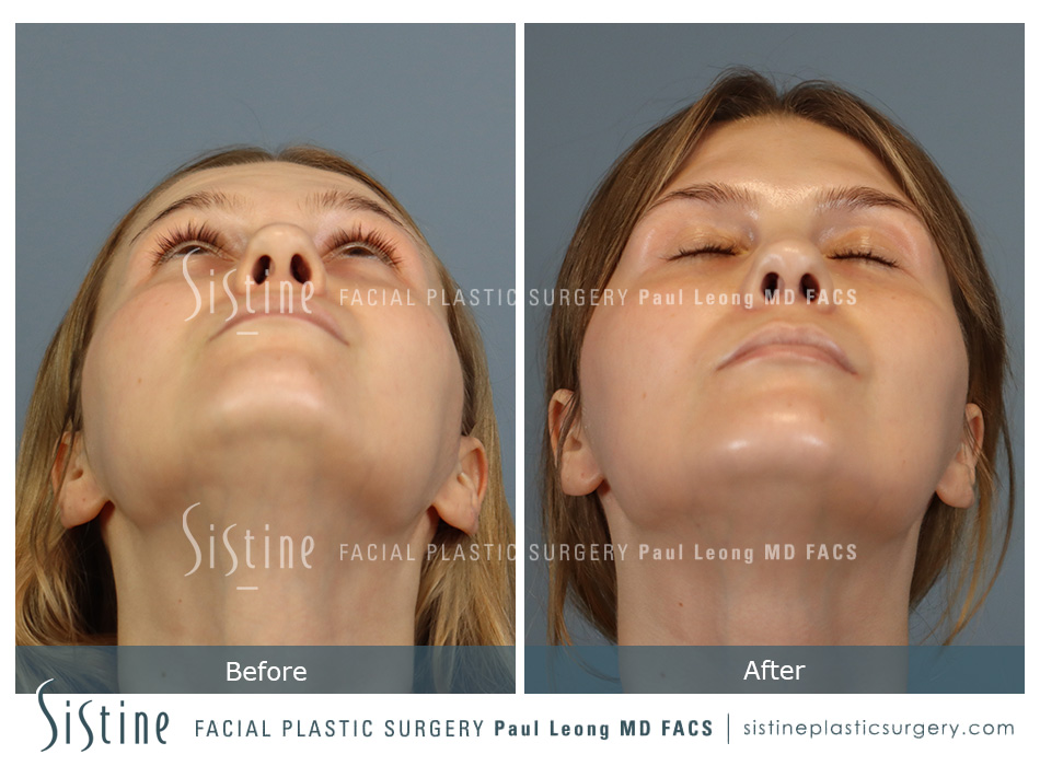 Rhinoplasty Before and After | Leong Facial Plastic Surgery