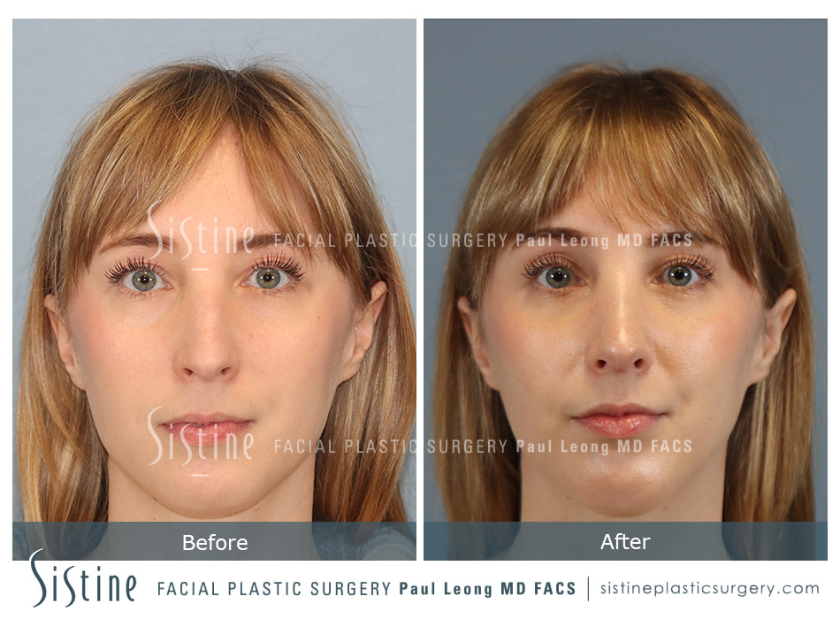 Rhinoplasty Before and After | Leong Facial Plastic Surgery