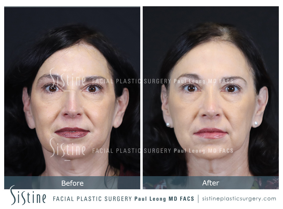 Rhinoplasty Before and After | Leong Facial Plastic Surgery