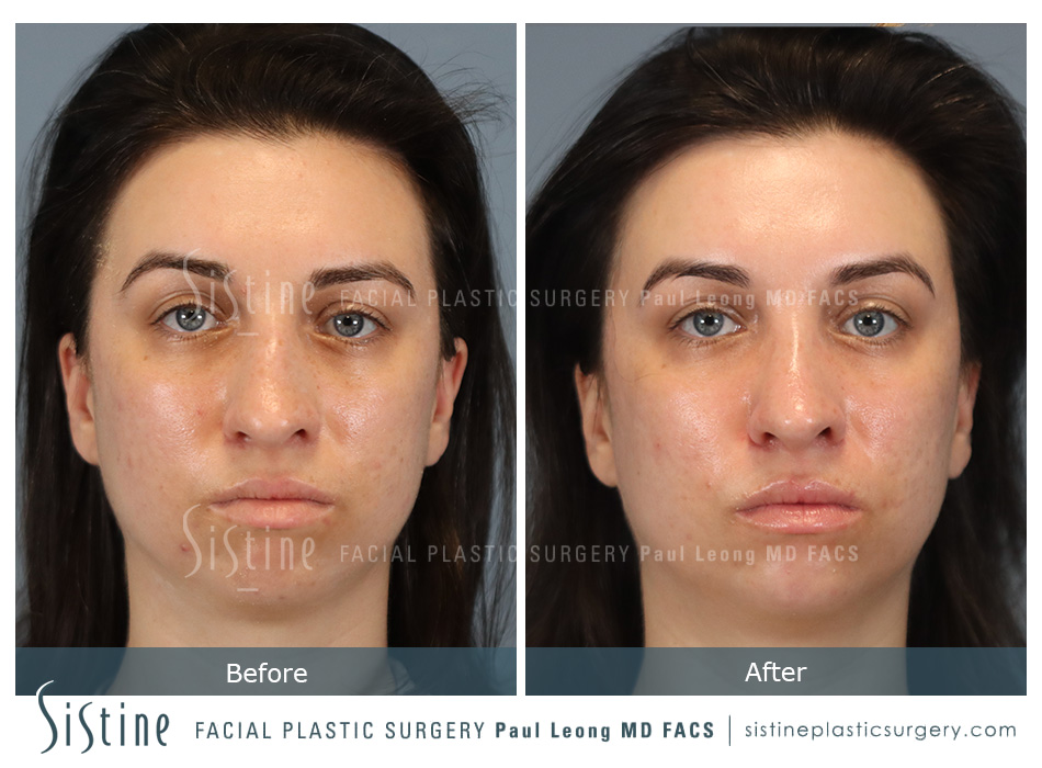 Rhinoplasty Before and After | Leong Facial Plastic Surgery