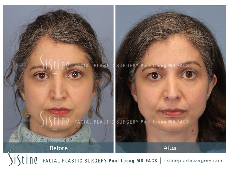 Rhinoplasty Before and After | Leong Facial Plastic Surgery