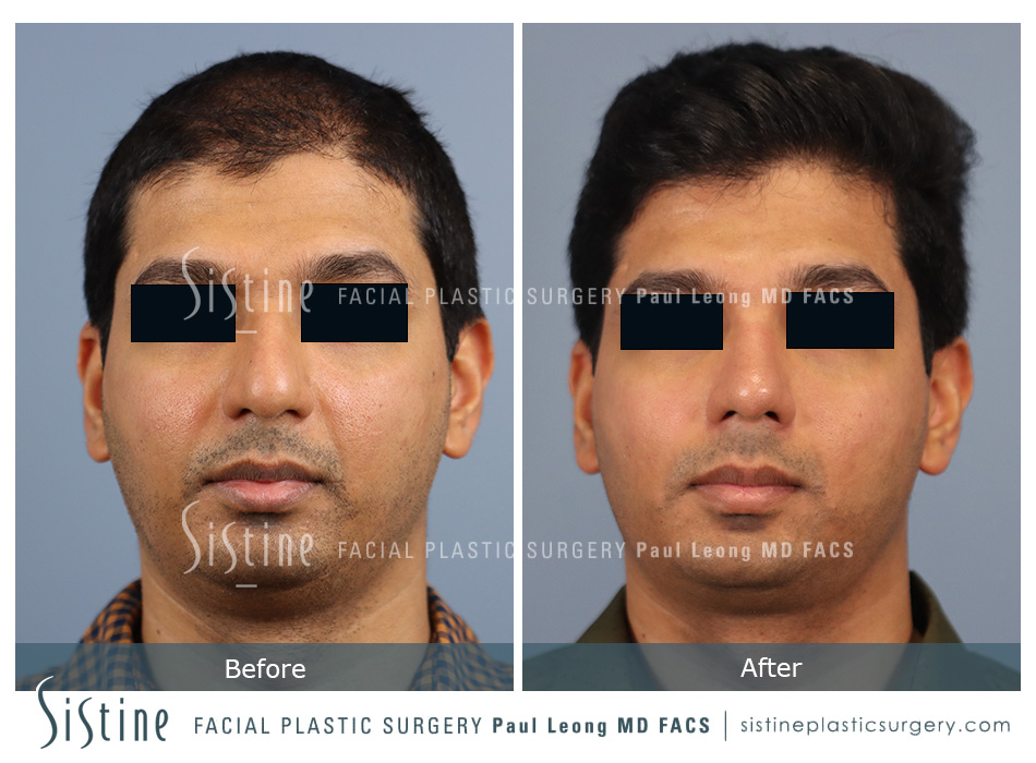 Rhinoplasty Before and After | Leong Facial Plastic Surgery