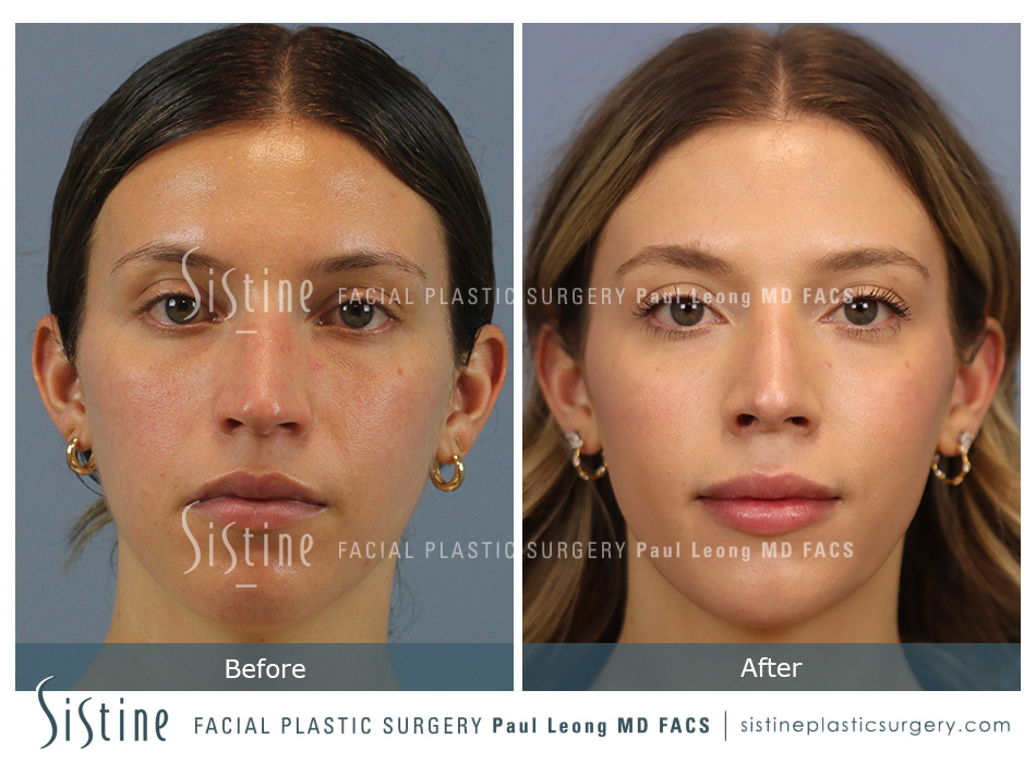 Rhinoplasty Before and After | Leong Facial Plastic Surgery