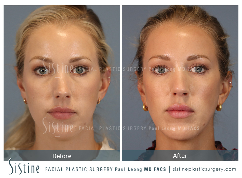 Rhinoplasty Before and After | Leong Facial Plastic Surgery