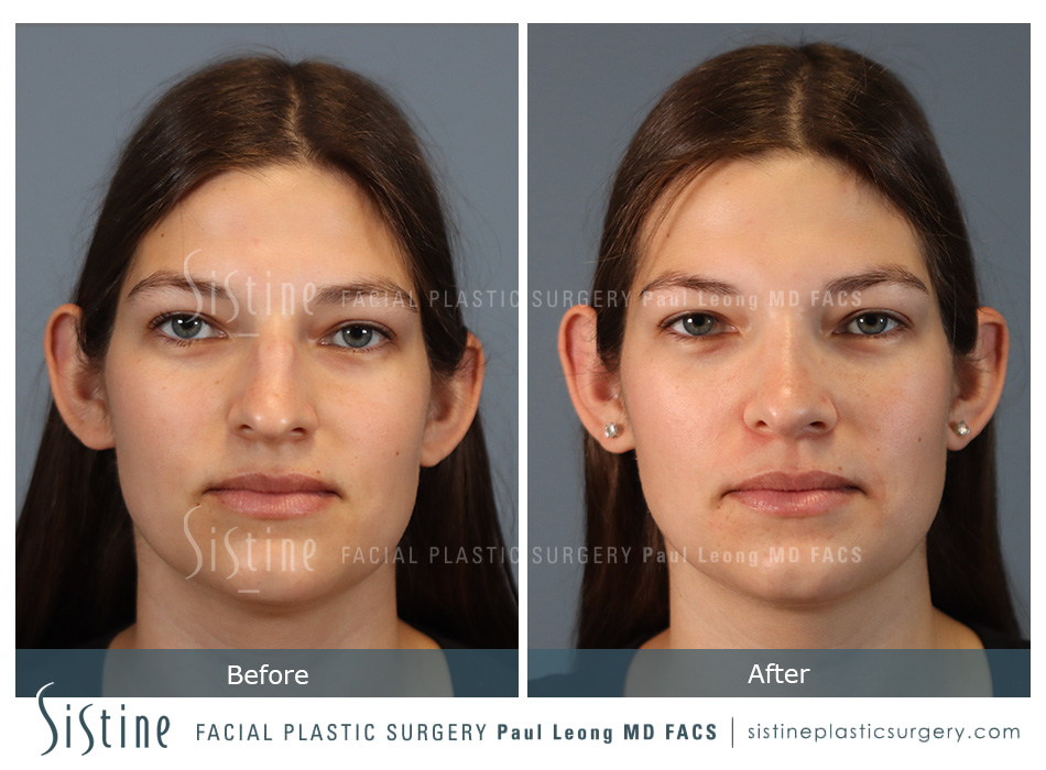 Rhinoplasty Before and After | Leong Facial Plastic Surgery