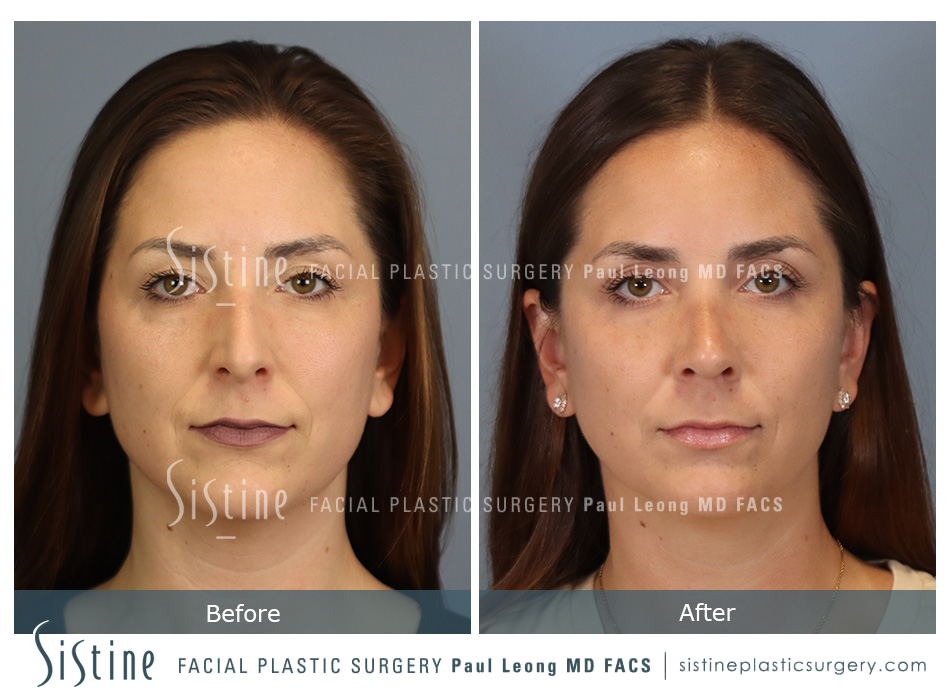 Rhinoplasty Before and After | Leong Facial Plastic Surgery