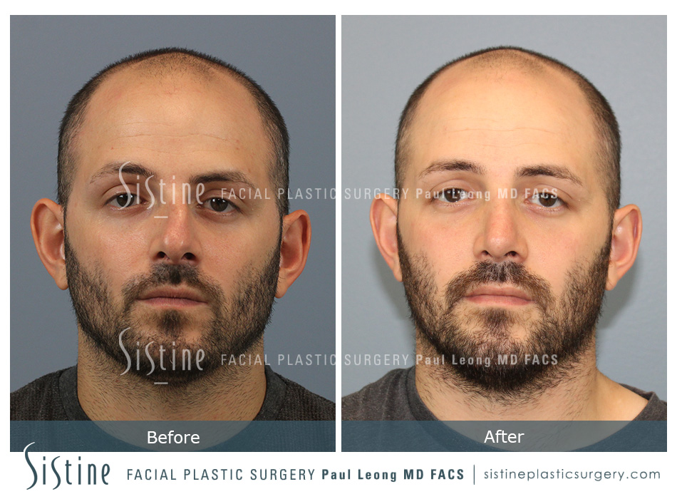 Rhinoplasty Before and After | Leong Facial Plastic Surgery