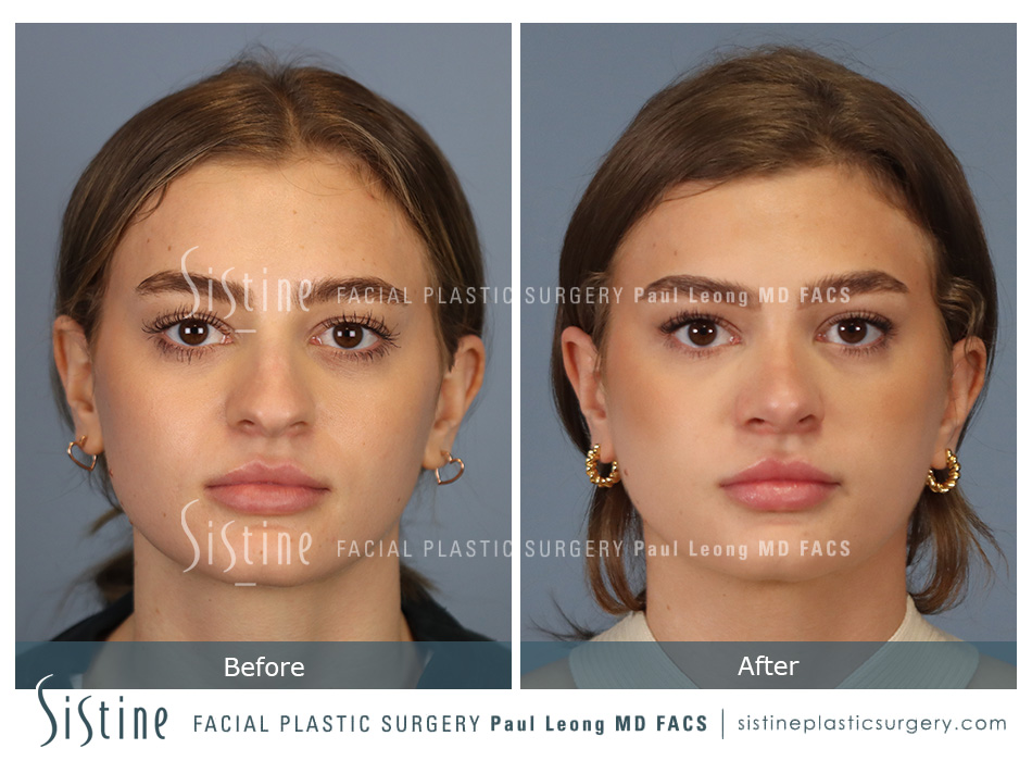 Rhinoplasty Before and After | Leong Facial Plastic Surgery