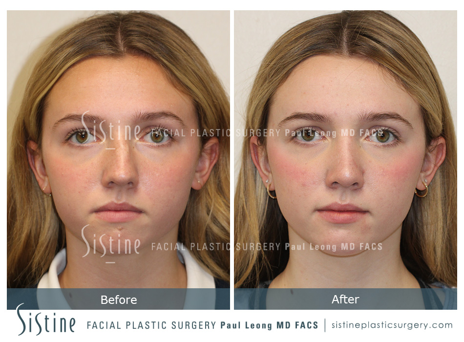 Rhinoplasty Before and After | Leong Facial Plastic Surgery