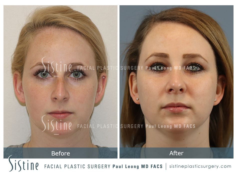 Rhinoplasty Before and After | Leong Facial Plastic Surgery