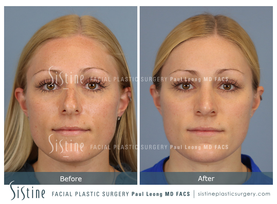 Rhinoplasty Before and After | Leong Facial Plastic Surgery