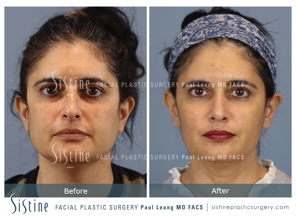 Rhinoplasty Before and After | Leong Facial Plastic Surgery