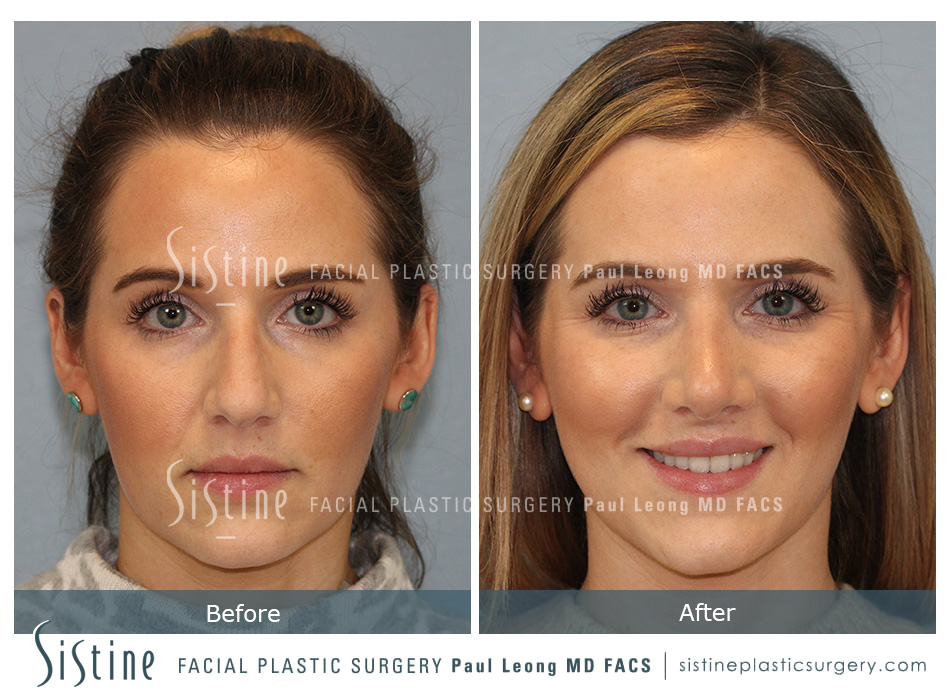 Rhinoplasty Before and After | Leong Facial Plastic Surgery