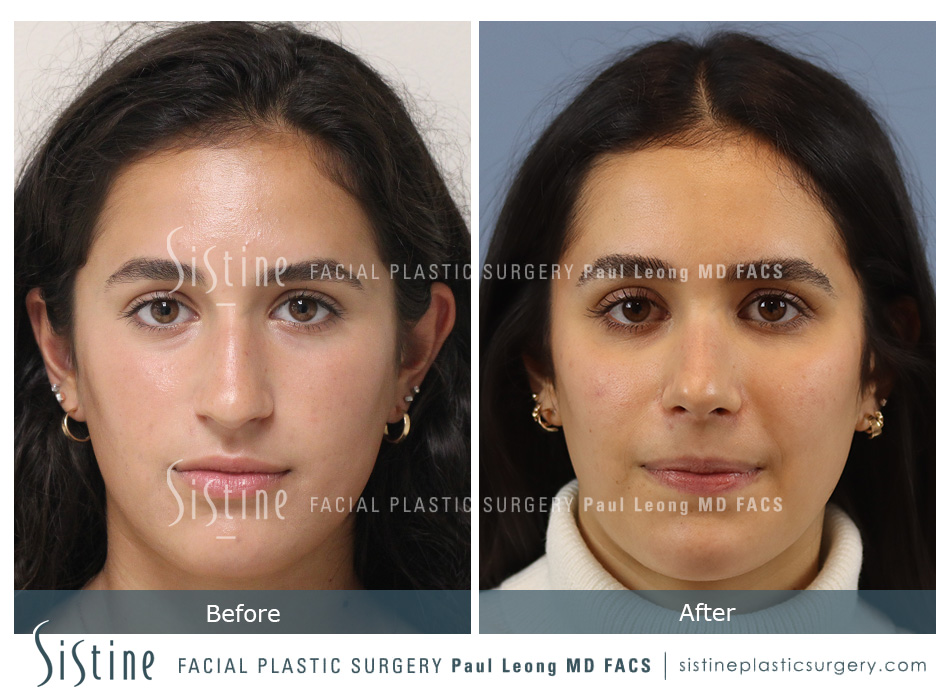 Rhinoplasty Before and After | Leong Facial Plastic Surgery