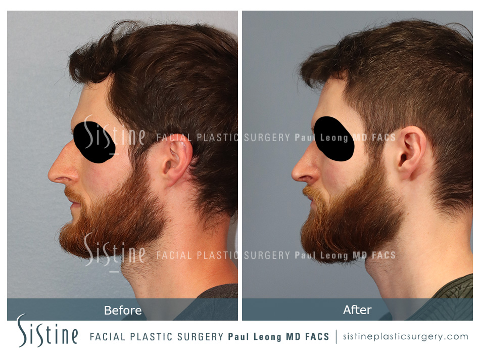 Rhinoplasty Before and After | Leong Facial Plastic Surgery