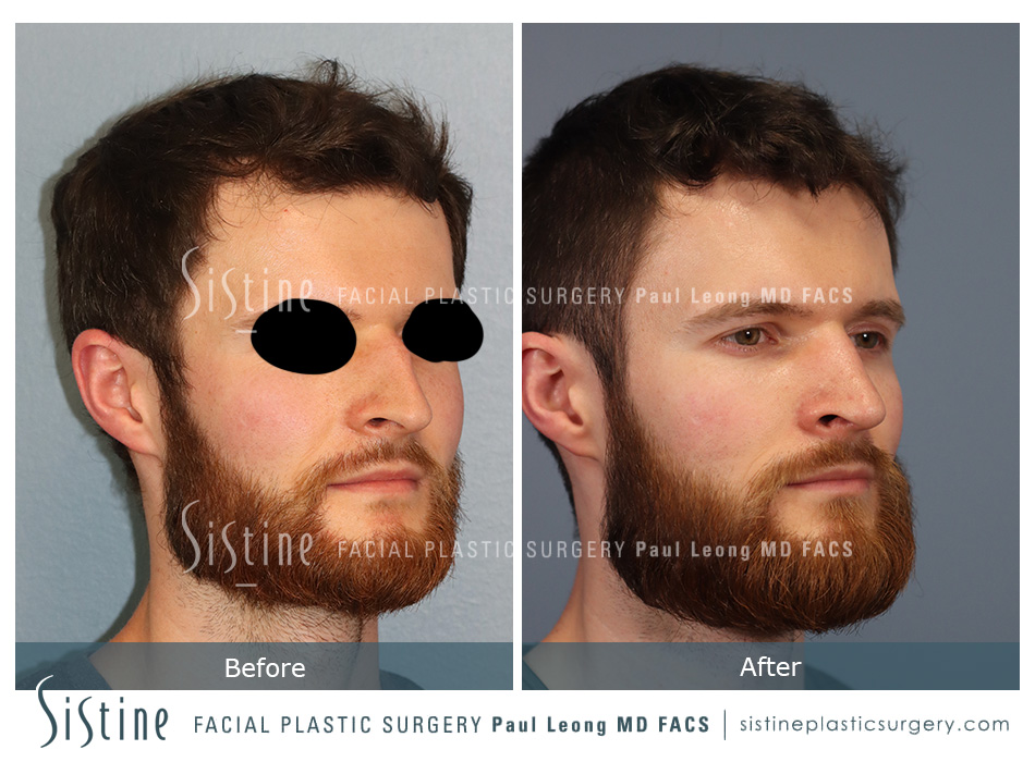 Rhinoplasty Before and After | Leong Facial Plastic Surgery