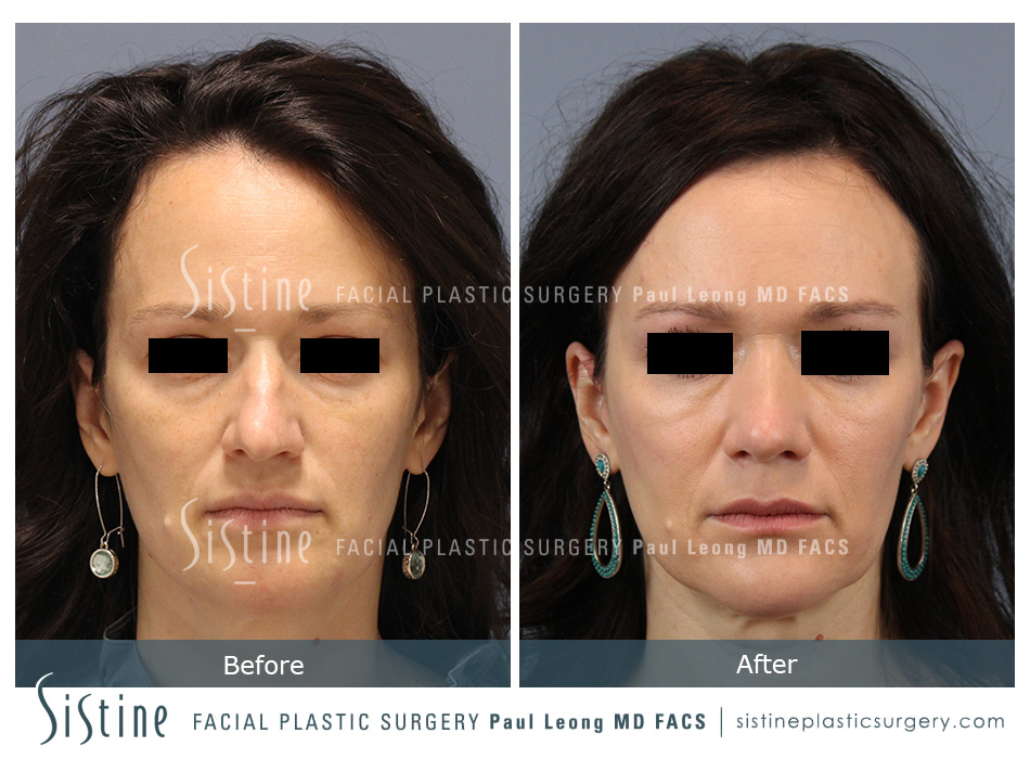 Rhinoplasty Before and After | Leong Facial Plastic Surgery