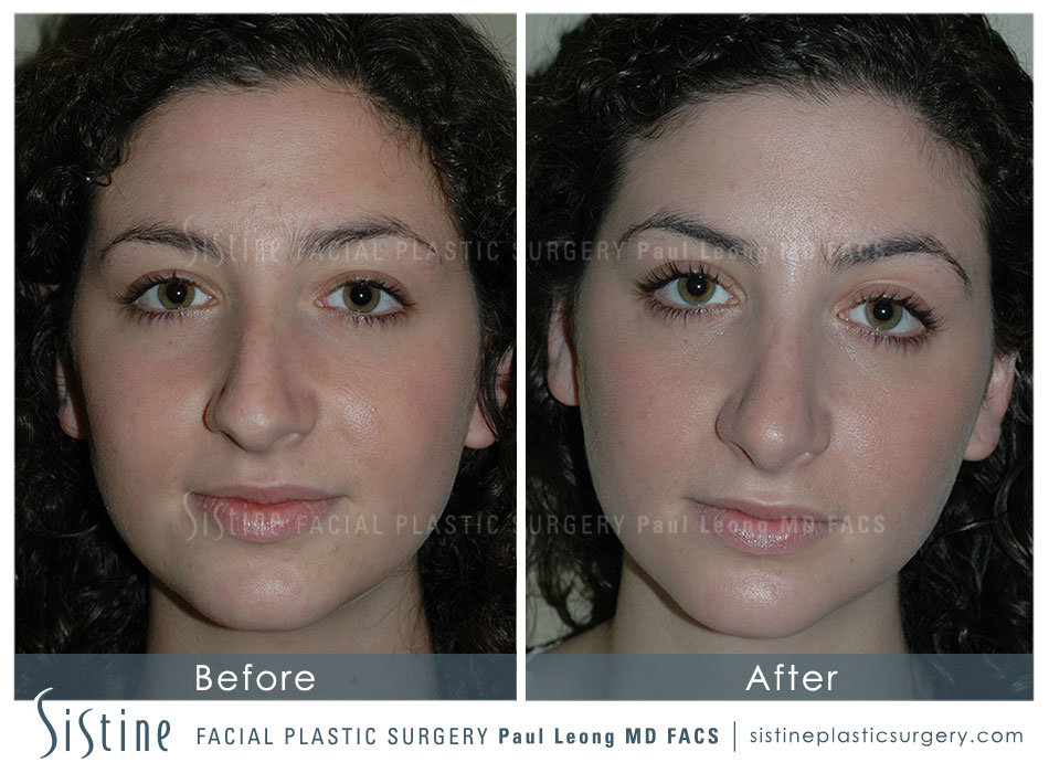 Rhinoplasty Before and After | Leong Facial Plastic Surgery