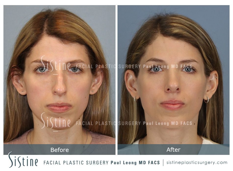 Rhinoplasty Before and After | Leong Facial Plastic Surgery