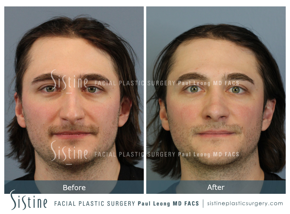 Rhinoplasty Before and After | Leong Facial Plastic Surgery