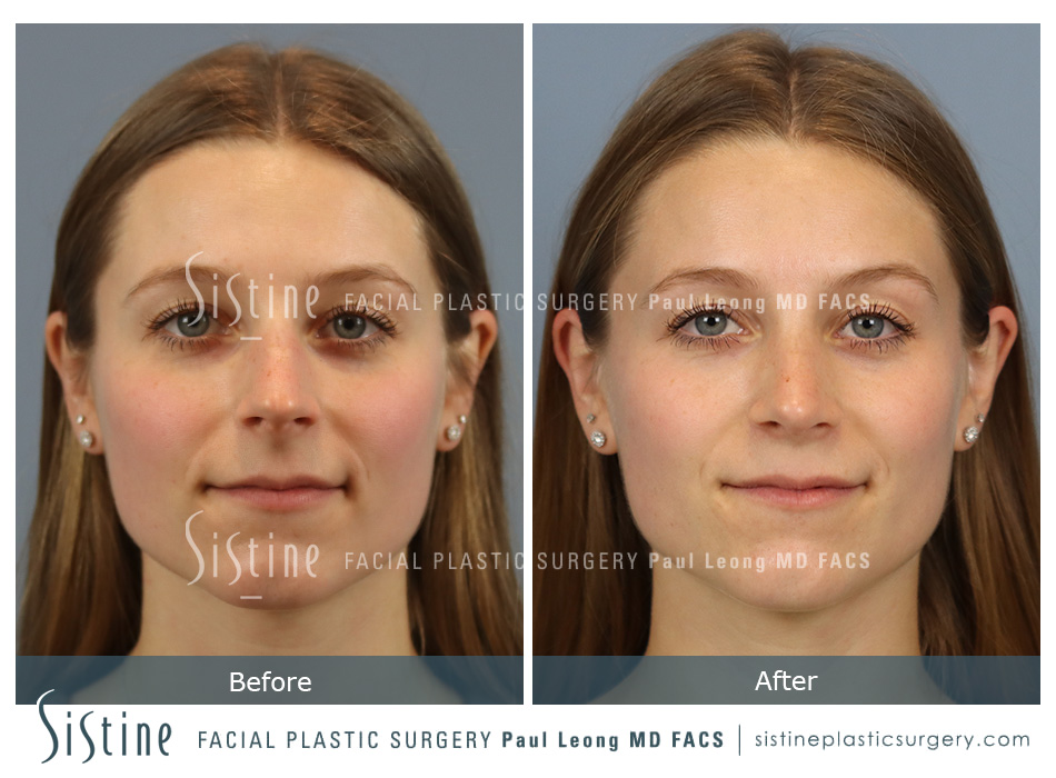 Rhinoplasty Before and After | Leong Facial Plastic Surgery