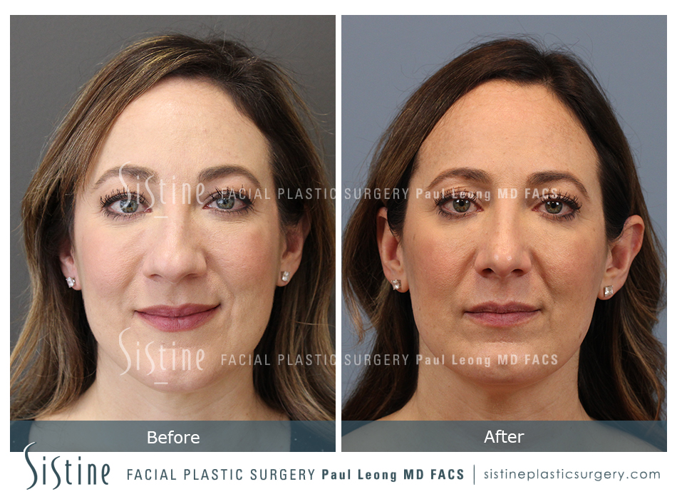 Rhinoplasty Before and After | Leong Facial Plastic Surgery