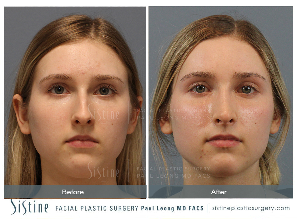 Rhinoplasty Before and After | Leong Facial Plastic Surgery