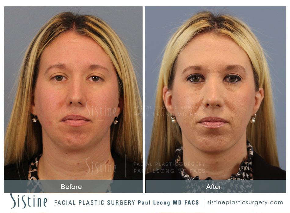 Rhinoplasty Before and After | Leong Facial Plastic Surgery