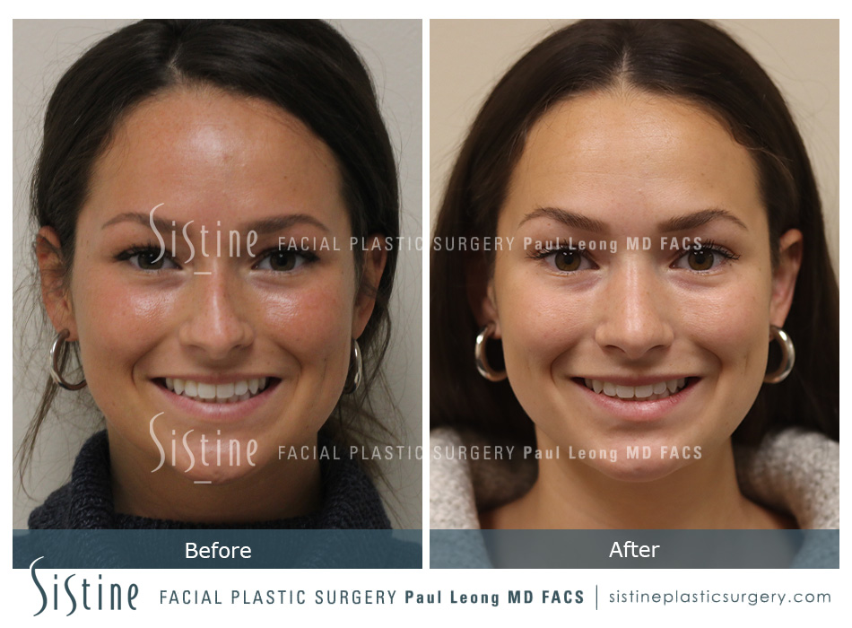 Rhinoplasty Before and After | Leong Facial Plastic Surgery