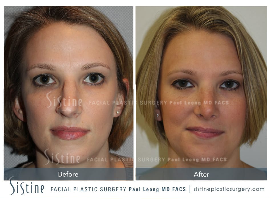 Rhinoplasty Before and After | Leong Facial Plastic Surgery