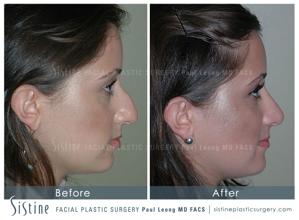 Rhinoplasty Before and After | Leong Facial Plastic Surgery