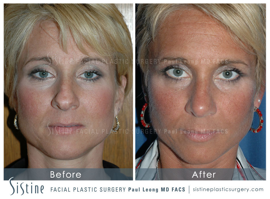 Rhinoplasty Before and After | Leong Facial Plastic Surgery