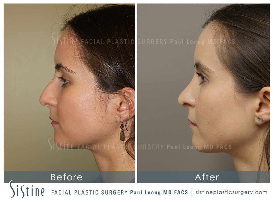 Rhinoplasty Before and After | Leong Facial Plastic Surgery