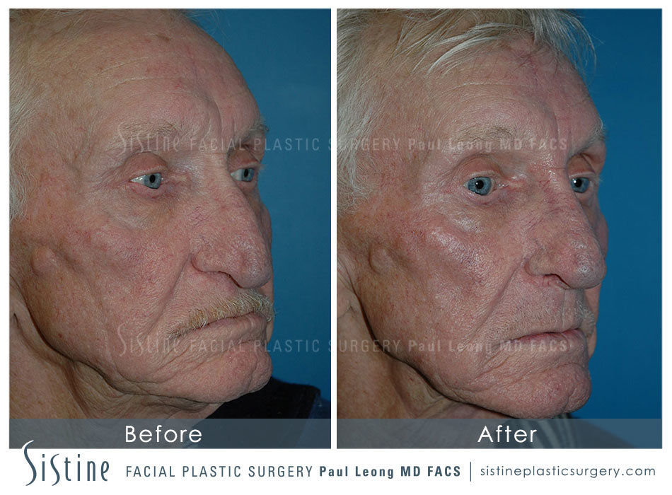 Rhinoplasty Before and After | Leong Facial Plastic Surgery