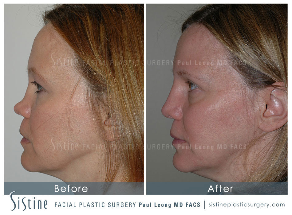 Rhinoplasty Before and After | Leong Facial Plastic Surgery