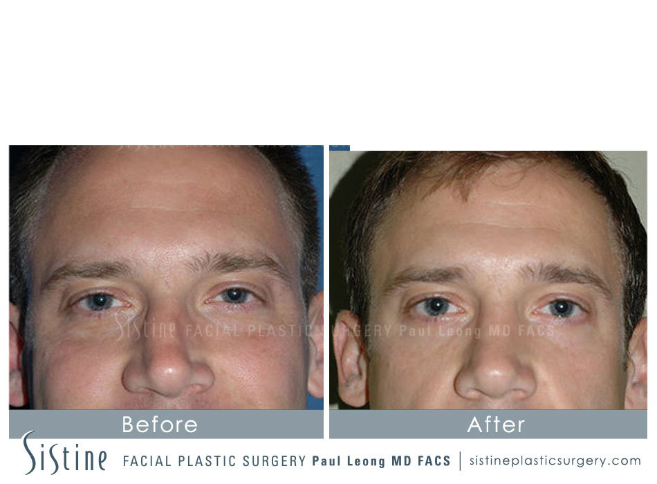 Rhinoplasty Before and After | Leong Facial Plastic Surgery