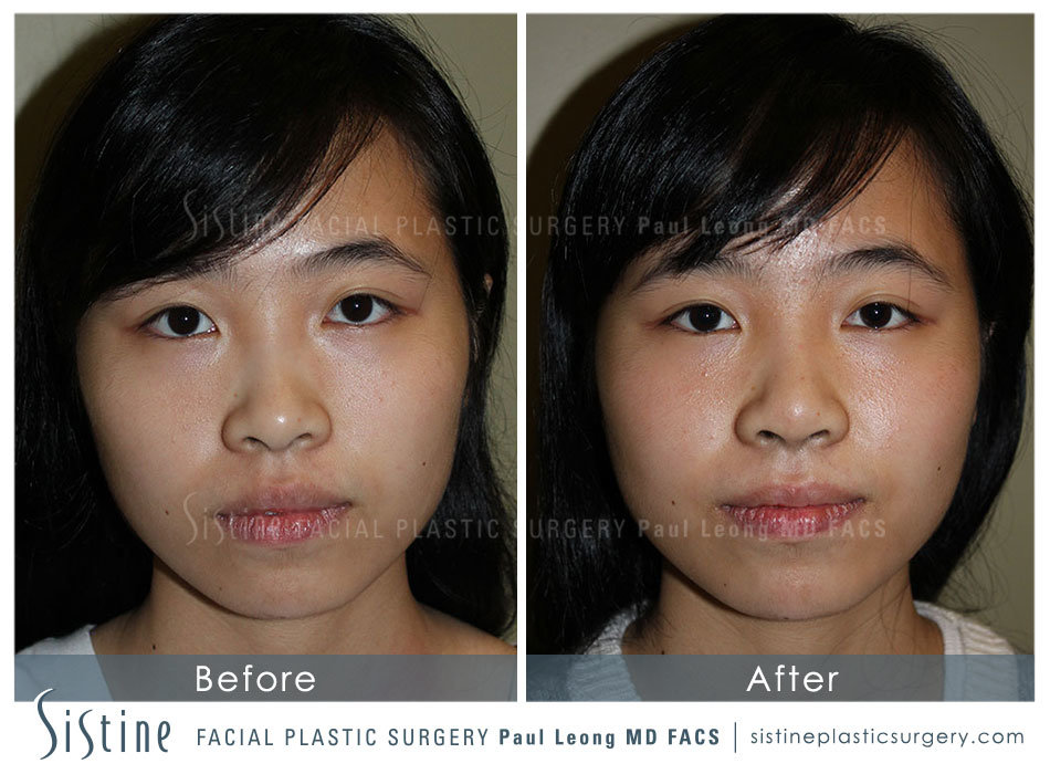 Rhinoplasty Before and After | Leong Facial Plastic Surgery