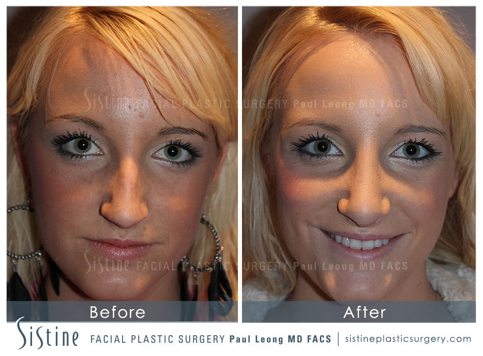 Rhinoplasty Before and After | Leong Facial Plastic Surgery