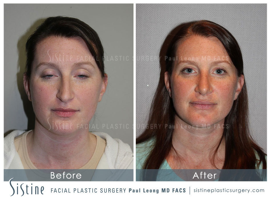 Rhinoplasty Before and After | Leong Facial Plastic Surgery