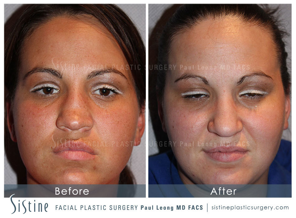 Rhinoplasty Before and After | Leong Facial Plastic Surgery