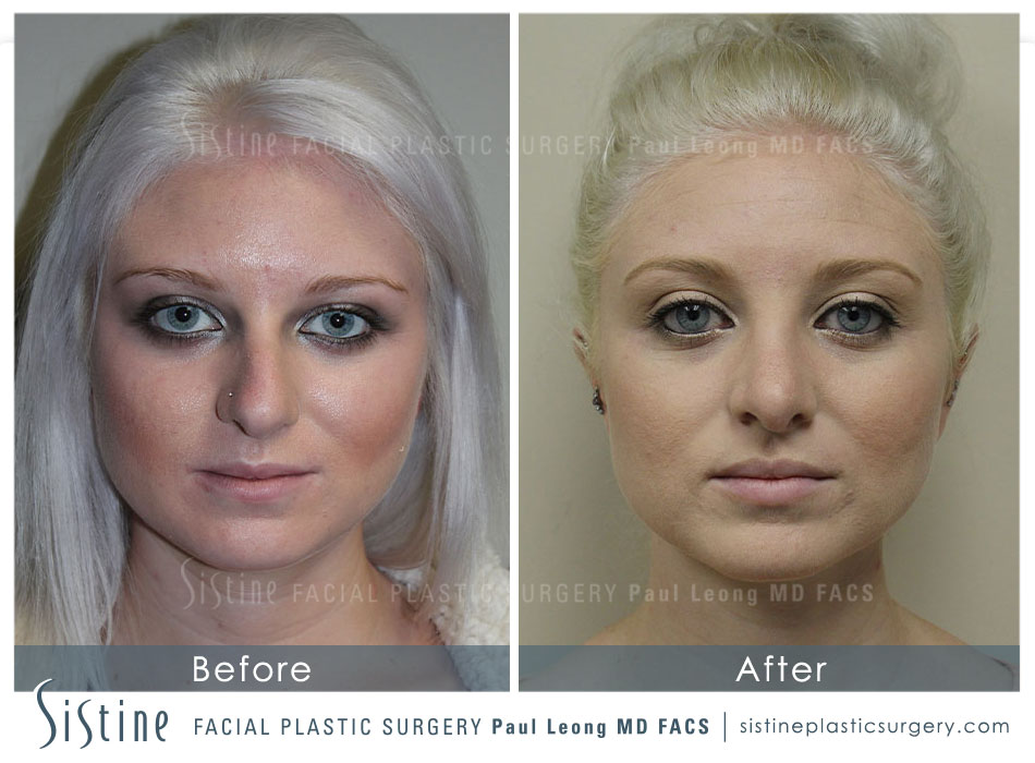 Rhinoplasty Before and After | Leong Facial Plastic Surgery