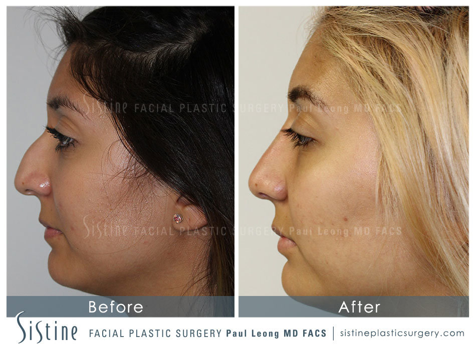 Rhinoplasty Before and After | Leong Facial Plastic Surgery