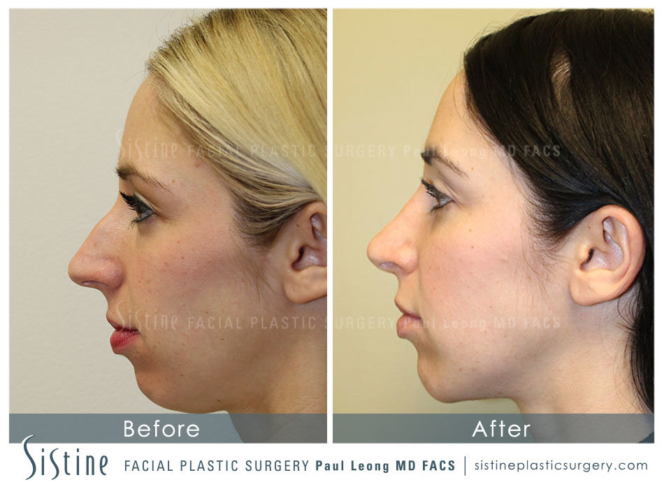 Rhinoplasty Before and After | Leong Facial Plastic Surgery