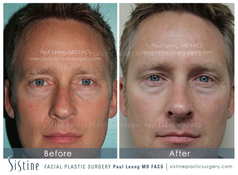 Rhinoplasty Before and After | Leong Facial Plastic Surgery