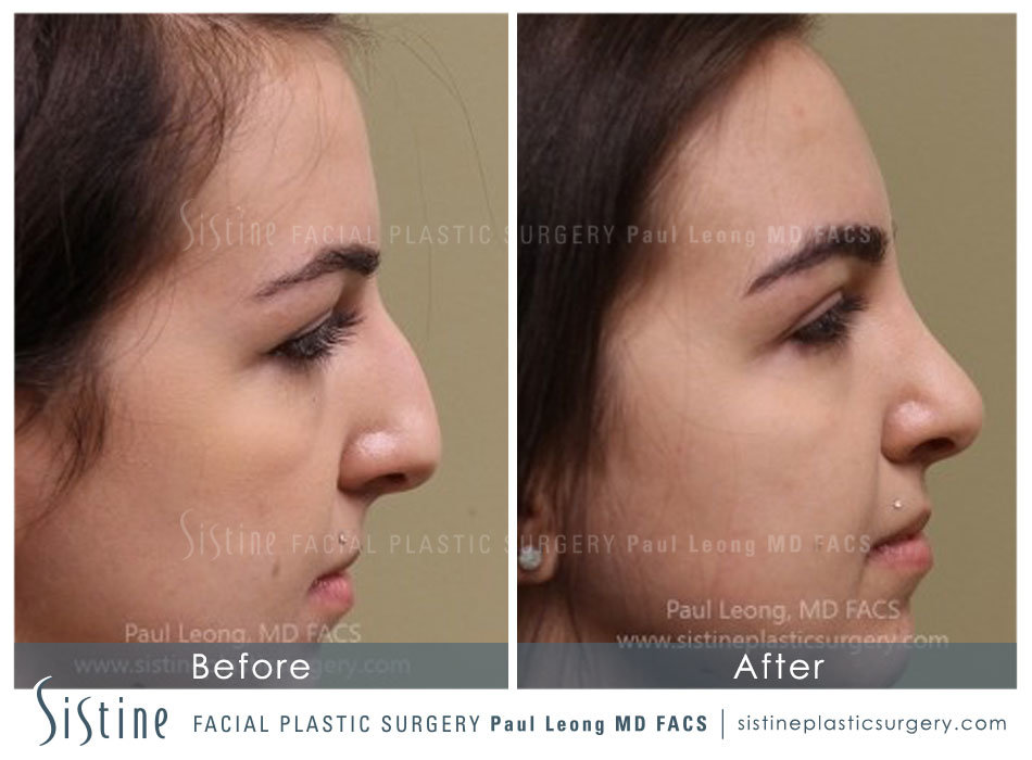 Rhinoplasty Before and After | Leong Facial Plastic Surgery